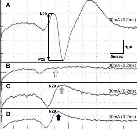 SEP recordings during CEA (A, before cross-clamping of the ICA; B, during cross-clamping; C, after shunt placement and D, at the end of CEA); the N20-P25 amplitude diminished during cross-clamping (B, white arrow); it recovered after shunt placement (C, gray arrow and D, black arrow).