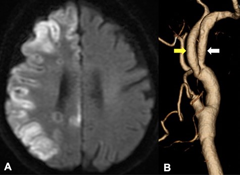 DWI in MRI demonstrated the new ischemic brain lesions on DWI 1 day after CEA in the right cerebral hemisphere cortex of the right ICA region (A); CTA demonstrated favorable patency of all arteries with an improvement of the internal carotid stenosis (B, yellow arrow: ICA, white arrow: PPHA).