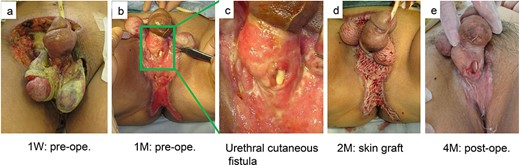 (a) A 47-year-old man was taken to our critical care center for septic shock due to necrotizing fasciitis, and his vulvar skin was extensively necrotic. (b, c) Extensive skin necrosis further progressed, with about half of the total penile skin lost in the penis, bilateral testicular exposure and urethral cutaneous fistula. (d, e) Two months after admission, the raw surface was able to be closed by mesh skin grafting, but the urethral cutaneous fistula widened steadily.