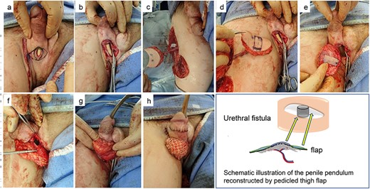 (a–c) One year after admission, the damaged tissue around the fistula was refreshed, and then the medial thigh perforator flap with the descending branch of the lateral femoral circumflex vessels was harvested. (d–f) Epithelial component of the medial thigh perforator flap was inserted invertedly to the urethral mucosal defect, and the de-epithelized component of the flap was adhered to the de-epithelized penile dermis; consequently, the urethral cutaneous fistula was closed. (g, h) A mesh skin graft was placed on the fat layer at the back of the flap to form a scrotum-like shape.