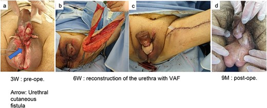 (a) A 62-year-old man developed sepsis after vulvar necrotizing fasciitis and underwent emergency incision and continuous lavage. Skin defects in the penile pendulum and scrotum developed 3 weeks later, consequently resulting in complication with urethral cutaneous fistula. (b) To close the fistula, we planned reconstructive surgery using a VAF pedicled with the great saphenous vein and the accompanying artery of the cutaneous nerve. (c) Using the same procedure as in Case 1, the de-epithelized component of the flap was extensively adhered to the de-epithelized penile dermis to close the urethral cutaneous fistula. (d) Nine months after reconstruction, the fistula had not relapsed, but unfortunately, excreting urine by himself was still extremely difficult for the patient