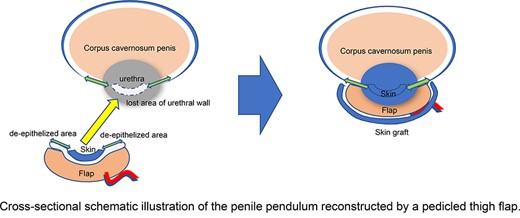 Cross-sectional schematic illustration of the penile pendulum reconstructed by a pedicled thigh flap.