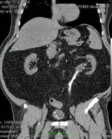 CT scan of abdomen showing left JJ stent in place with multiple upper ureteric stones with obvious leak.