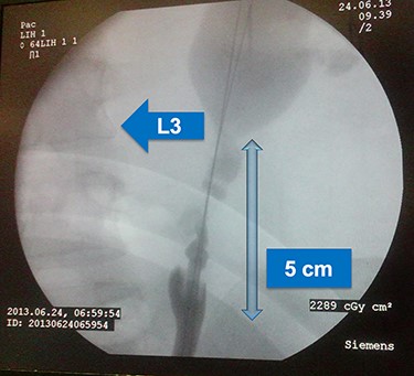 Retrograde pyelogram showing invagination of mid ureter for about 4–5 cm, lumbar vertebra 3 is shown for orientation.