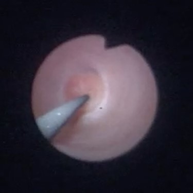 Endoscopic image during ureteroscopy showing ante-grade invagination of the ureter.