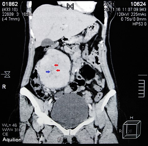 Contrast-enhanced abdominal CT scan shows a large heterogeneous mass adjacent to the inferior margin of the liver measuring (11.5 × 8.5 × 9 cm) and containing calcified areas (red arrows) and necrosis (blue arrow).