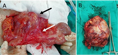 (A) Intraoperative image shows the large well-defined mass that locates in the mesentery (black arrow) and is attached to the ascending colon (white arrow). (B) The mass after resection.