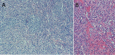 (A) Microscopic examination based on Hematoxylin and Eosin (H&E) stain reveals atrophy of follicles and onion skin appearance. (B) Prominent vascular proliferation and hyalinization of vessel walls.