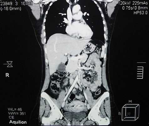 Contrast-enhanced abdominal CT scan 5 months after surgery shows full recovery and no evidence of recurrence.