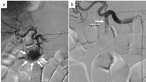 Emergency angiography; (a) emergency angiography showing the hypervascular tumor in the pancreas head (white arrow); (b) embolization of the gastroduodenal artery (white arrow).