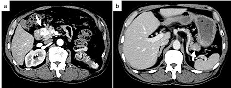 Axial contrast-enhanced CT images; (a) CT showing a 25-mm well-defined hypervascular heterogeneous lesion in the pancreas head; (b) CT showing a 9-mm well-defined hypervascular heterogeneous lesion in the pancreas tail. White arrows indicate the tumor in the pancreas head and tail.