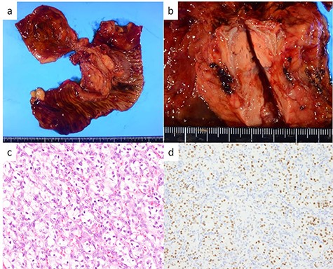Resected specimen and pathological findings of the pancreatic head tumor; (a, b) a yellow 38-mm solid tumor in the pancreatic head protruding into the duodenum; (c) abundant nests of large clear cells (hematoxylin and eosin ×400); (d) immunohistological positivity for PAX8 (PAX stain ×200).