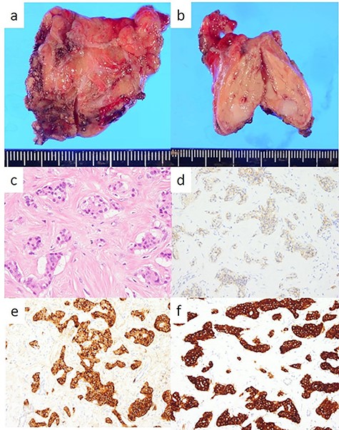 Resected specimen and pathological findings of the pancreatic tail tumor; (a, b) a white 6-mm solid tumor in the pancreatic tail; (c) abundant nests of large clear cells (hematoxylin and eosin ×400); (d) immunohistological positivity for CD56 (CD56 stain ×200); (e) immunohistological positivity for chromogranin A (chromogranin A stain ×200); (f) immunohistological positivity for synaptophysin (synaptophysin stain ×200).