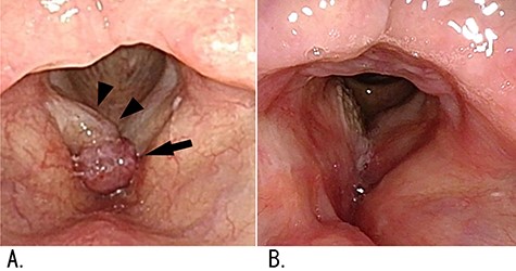 Findings of laryngeal flexible-endoscopy examination; (A) preoperative findings: a red tumor on the anterior commissure of the larynx (arrow) and a diffuse swelling of the right vocal fold (arrowheads) were identified; (B) no recurrence was found 3.5 years after surgery.