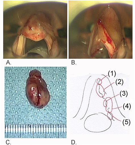 Findings of laryngeal microsurgery; (A) a recurrent red tumor was encountered at the anterior commissure of the larynx; (B) swelling of the right vocal fold was identified after removal of the red tumor; (C) the red tumor measured 15 × 9 mm and was soft; (D) numbers indicate biopsied areas of the right vocal fold.
