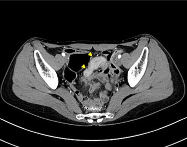 Computed tomographic scan showing a continuous lesion to the ileum with contrast enhancement (arrowheads).