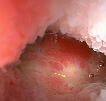 Double-ballon enteroscopy showing an ulcerated lesion (arrow) at 160 centimeters from the ileocecal valve.