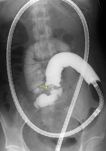 Double-ballon enteroscopy-assisted contrast study demonstrating intestinal stenosis involving a Meckel’s diverticulum (arrow).