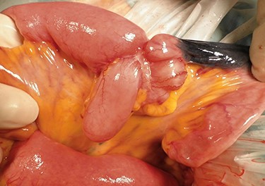 Operative findings showing tumor invasion involving a Meckel’s diverticulum at 160 centimeters from the ileocecal valve.