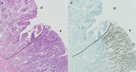 Histological evaluation of the resected specimen. (a) Hematoxylin and eosin stain showed a differentiated adenocarcinoma adjacent to the ectopic gastric mucosa (*: ectopic gastric mucosa, *: adenocarcinoma, ×40). (b) Immunohistochemical stain of CDX2 showed expression in a differentiated adenocarcinoma (*: ectopic gastric mucosa, *: adenocarcinoma, ×40)