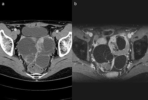 (a) Computed tomography scan showing a multi-cystic mass in the pelvis with a partial contrast effect. (b) Gadolinium-enhanced T2-weighted magnetic resonance image showing a solid mass with contrast effect in the cysts.
