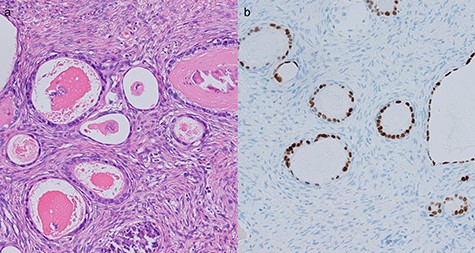 Histological evaluation of resected ovarian tissues. (a) Hematoxylin and eosin stain showed proliferation of atypical glandular ducts of various sizes, similar in morphology to those found in the intestinal tissue. (×200). (b) Immunohistochemical stain of CDX2 showed expression in glandular tissues (×200).