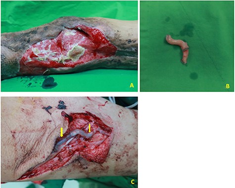 (A) A case of lower extremity necrotizing fasciitis after treatment with soft tissue defect at lateral aspect of the left knee with exposed joint and patella. (B). One segment of the cryopreserved hepatic artery (~3 cm length, ~2–3 mm diameter) at back table. (C) Cryopreserved hepatic artery was used to bridge one large-sized vena comitans (~3 mm diameter) toward the great saphenous vein branch (yellow arrows indicated the anastomotic sties of the cryopreserved vascular graft).