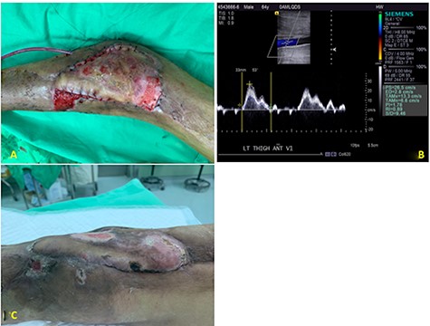 (A) The flap condition was stable with satisfactory healing at 1 week. (B) The color Doppler demonstrated the patency of cryopreserved vascular graft. (C) The wound condition with complete healing by the flap coverage at 2 months.