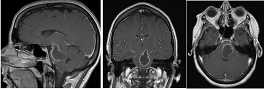 Pe-op axial, coronal and sagittal T1 post-contrast MRIs demonstrating rim-enhancing pontine abscess.