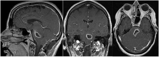 Post-op axial, coronal and sagittal T1 post-contrast MRIs demonstrating decrease size of rim enhancing pontine abscess.
