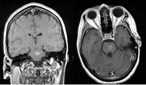 Post-op axial and coronal MRIs, 11 weeks following discharge, demonstrating resolution of the pontine abscess with small area of residual scarring; source: http://pacsweb.wjmc.org.