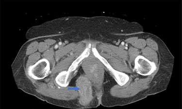 Preoperative CT demonstrating pararectal hernia (blue arrow).