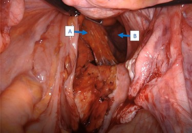 Intraoperative view of the rectum (A) herniating through a defect in the pelvic wall (B).