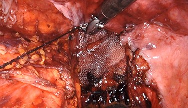 Intraoperative repair with 8 × 8 cm Phasix mesh.