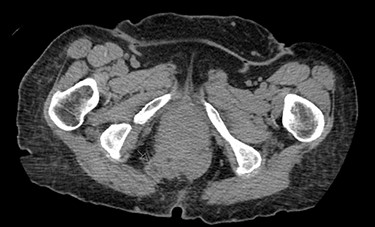 Post-operative CT demonstrating mild fluid in pelvis and resolution of the hernia (black arrow).