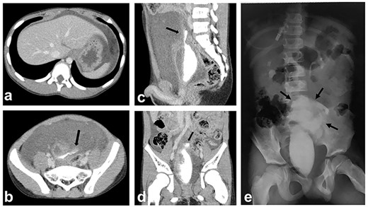 Enhanced CT and subsequent radiography; (a, b) enhanced CT shows a massive amount of intraperitoneal free fluid; (b–e) CT cystography and subsequent radiography show contrast material extravasating from the bladder; the contrast is confined to the intraperitoneal space (black arrows: extravasated contrast material).