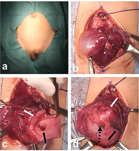 Intraoperative findings; (a) there are no visible contusions on the abdominal wall; (b) there is a large amount of bloody ascites in the abdominal cavity; massive edema and blood-tinged fluid are present anterior to the bladder; (c) two ruptures are visible along the dome of the bladder (white arrow: large rupture; black arrow: small rupture); (d) the bladder wall at the rupture sites is closed in three layers (white arrow: closure of large rupture; black arrow: closure of small rupture; black dotted arrow: stump of urachal remnant).