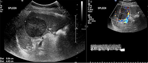 Ultrasound images with Doppler showing a well-defined rounded hypoechoic mass with vascularity in the peripheral areas as well as inside the lesion with no through transmission.