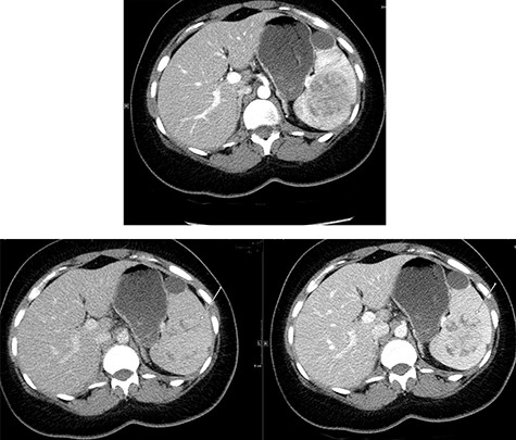 Top image shows abdominal CT scan arterial phase axial section with a hypodense, solitary, rounded and lobulated non-calcified mass lesion in spleen. Bottom right and left images show abdominal CT scan portovenous and delayed phase axial images showing a hypodense lesion and areas of filling (arrows in both images) which becomes mostly isodense to spleen; incidental finding of a splenic cyst.