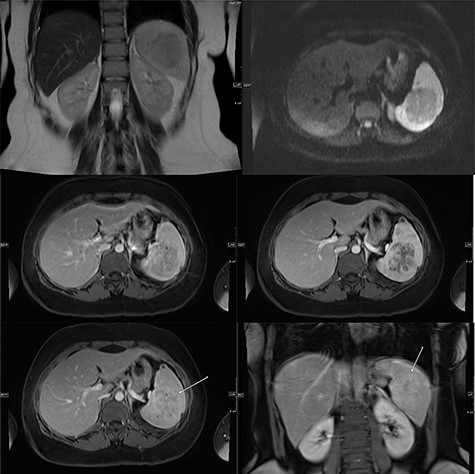(Top) coronal T2 WI MR Image showing a hypointense lesion in the spleen, which is not showing any diffusion restriction (right image); (middle images) post-contrast axial T1 WI MR image showing hypointense lesion with patchy contrast enhancement in the center (middle right image); the lesion becomes further isointense on delayed image (middle left image); (bottom) MRI of abdomen T1 weighted axial (bottom left) and coronal (bottom right) post-contrast images showing a lesion in the spleen (arrow) with peripheral and septal enhancement with a hypoenhancing center.