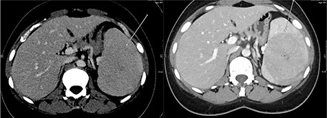 The post-contrast CT axial image showing central hypodense splenic lesion in portovenous phase (arrow—right image) which becomes isodense on delayed images (arrow—left image).