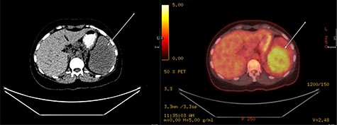 PET fused axial image with corresponding low-dose unenhanced CT image (left); the lesion is showing moderate FDG uptake (arrow).