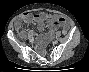CTAP showing multiple loops of dilated small bowel with transition point in the right iliac fossa.