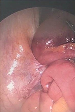 Paracaecal recess with a loop of obstructed small bowel trapped within.