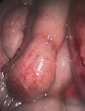Bruised but viable released small bowel loop.