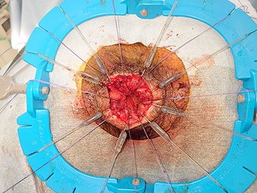 anus at the end of the Delorme’s procedure