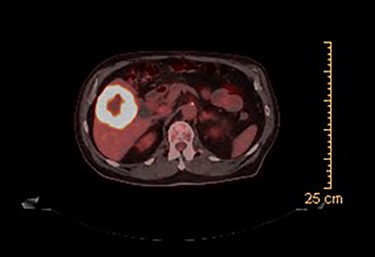 PET scan (axial view): hypermetabolic, centrally necrotic mass involving liver segment V, VI.