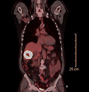 PET scan (coronal view).