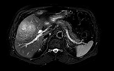 MRI (axial view): 7.1 × 8.1 cm mass originating from the gallbladder involving segments IVb, V, VI with areas of peripheral enhancement and central necrosis.