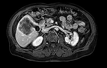 MRI (axial view).